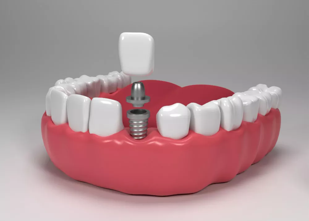 DENTAL IMPLANTS