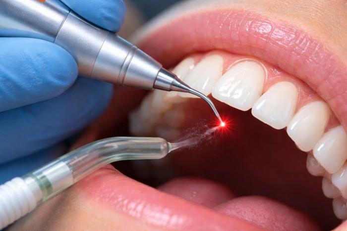 laser dentistry