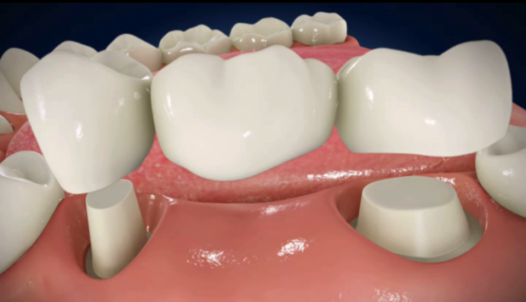 Dental-Bridge-860x494-1.png