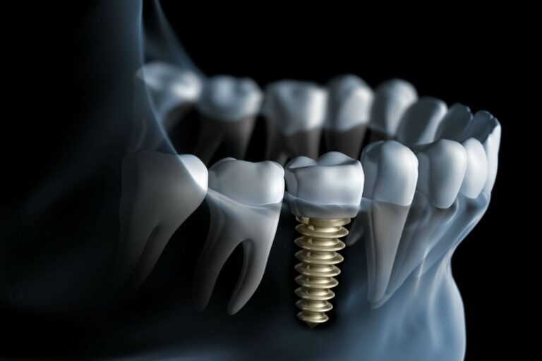 Dental-Implants3.jpeg