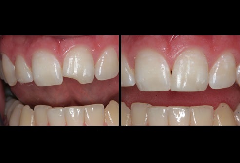 farley_photo_of_bonded_chipped_tooth-1.jpg