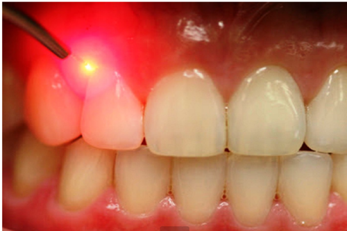 laser-dental-treatments-500x500-1.png
